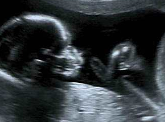 胎儿左心室的强回声光点是什么意思？